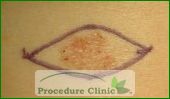Excisional biopsy